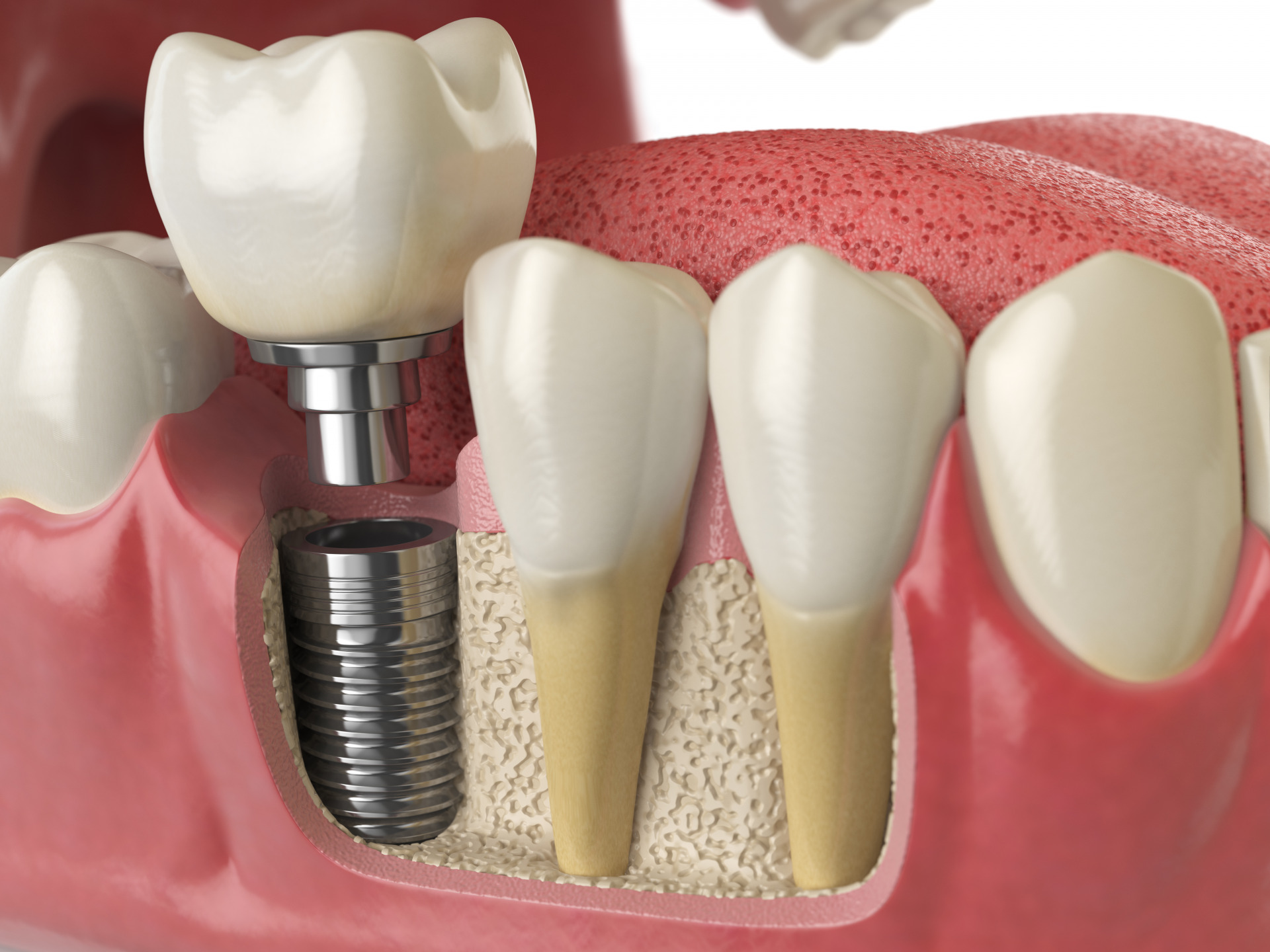 Thực hiện gắn răng sứ trên Implant để hoàn tất quá trình trồng răng