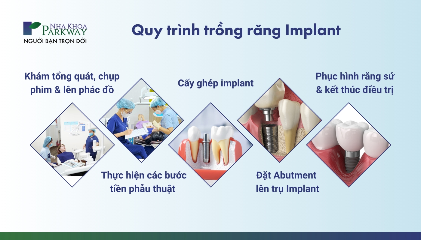 Quy trình trồng răng Implant