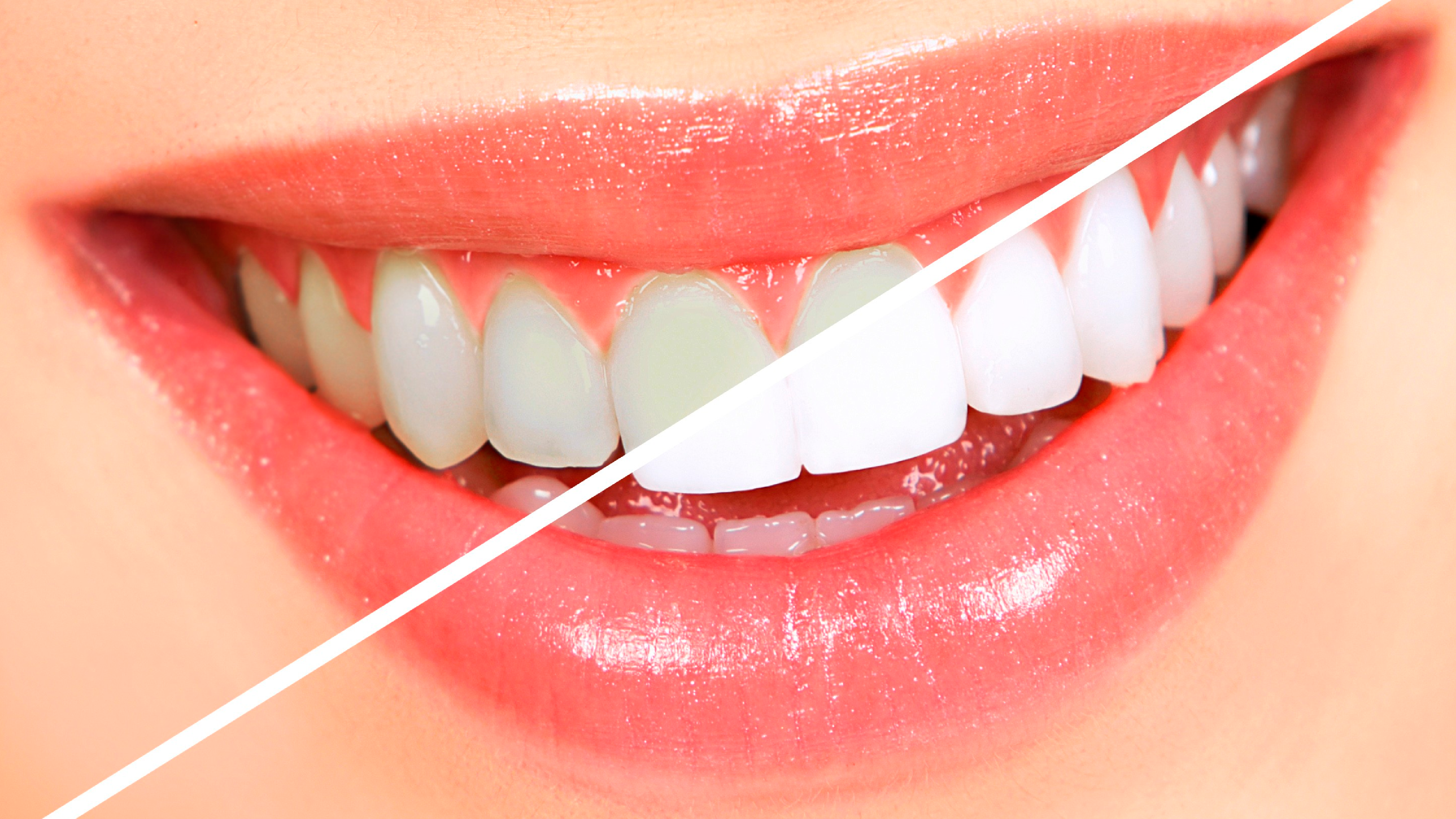 Dịch vụ tẩy trắng răng Laser Express | Nha Khoa Parkway