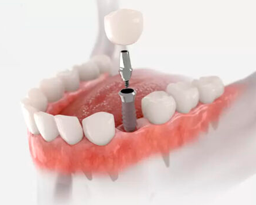 Trồng răng Implant Neoden Acqua