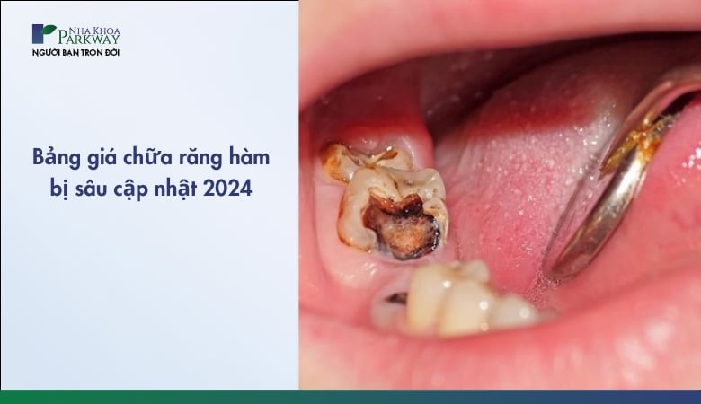 Chữa sâu răng hàm giá bao nhiêu - 1