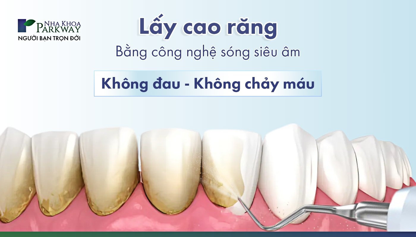 Lấy cao răng bằng công nghệ sóng âm: không đau - không chảy máu