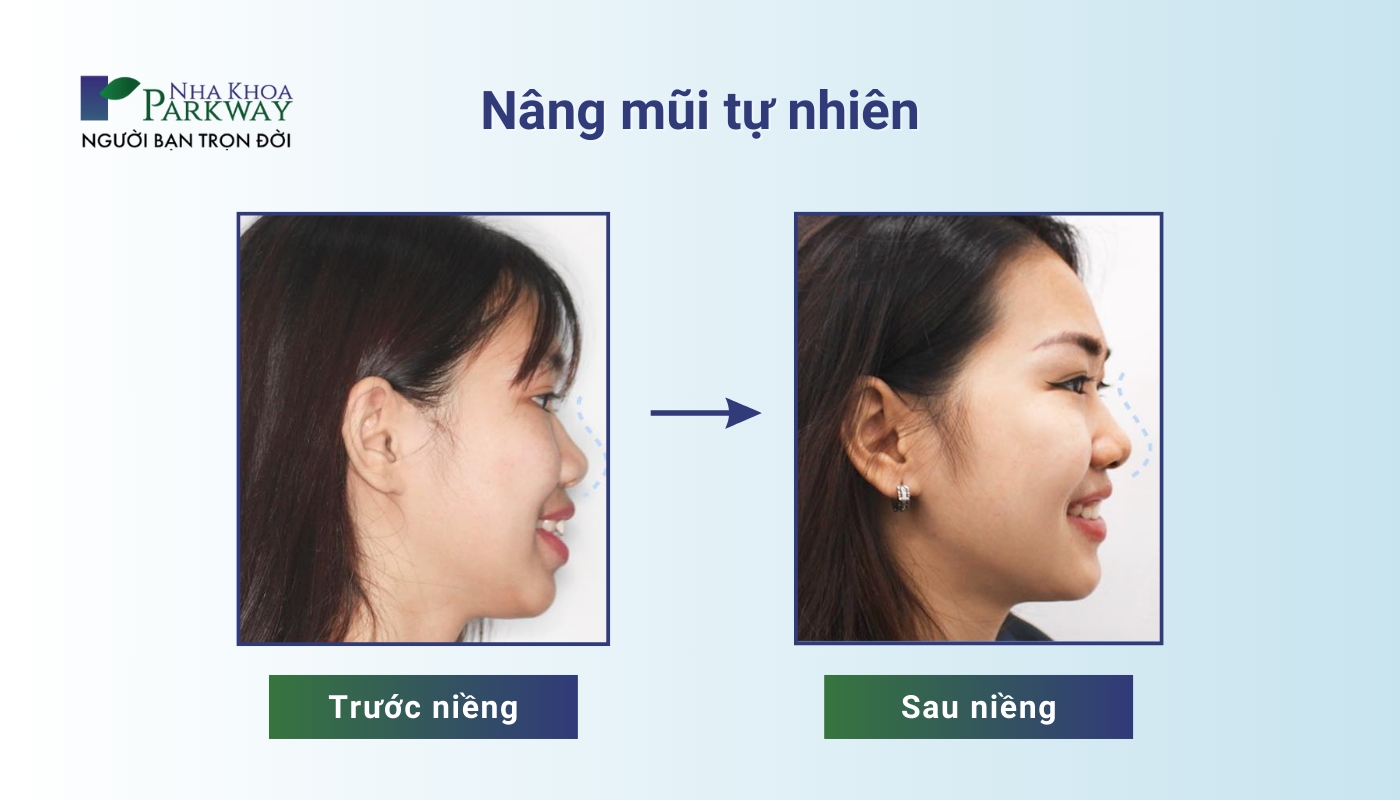 Khách hàng trước và sau khi niềng răng: Nhìn như được nâng mũi tự nhiên