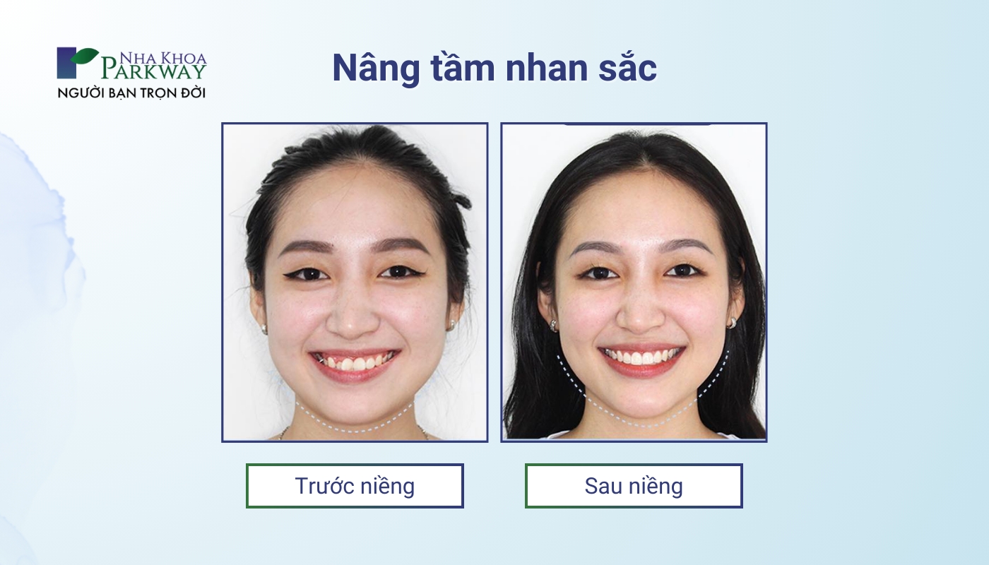 Nâng tầm nhan sắc: khách hàng trước và sau khi niềng răng