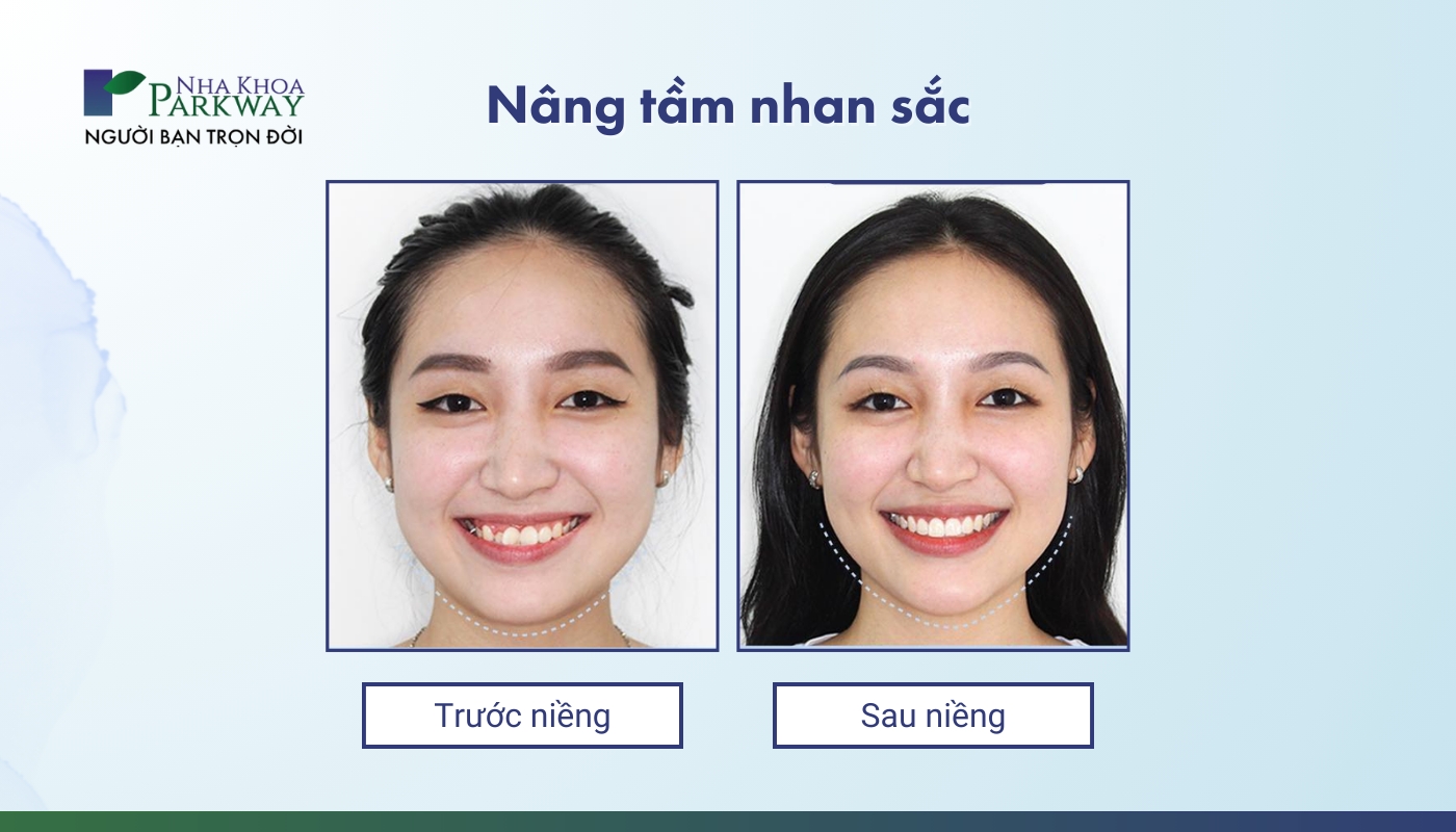 Hình ảnh cô gái trước và sau khi niềng răng trong suốt