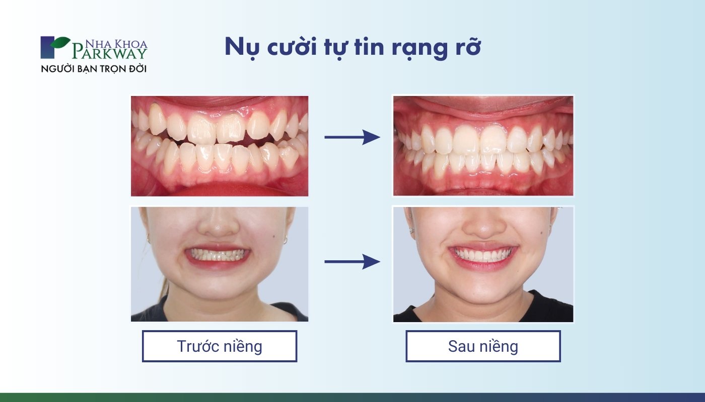 Nụ cười tự tin rạng rỡ: trước niềng và sau niềng