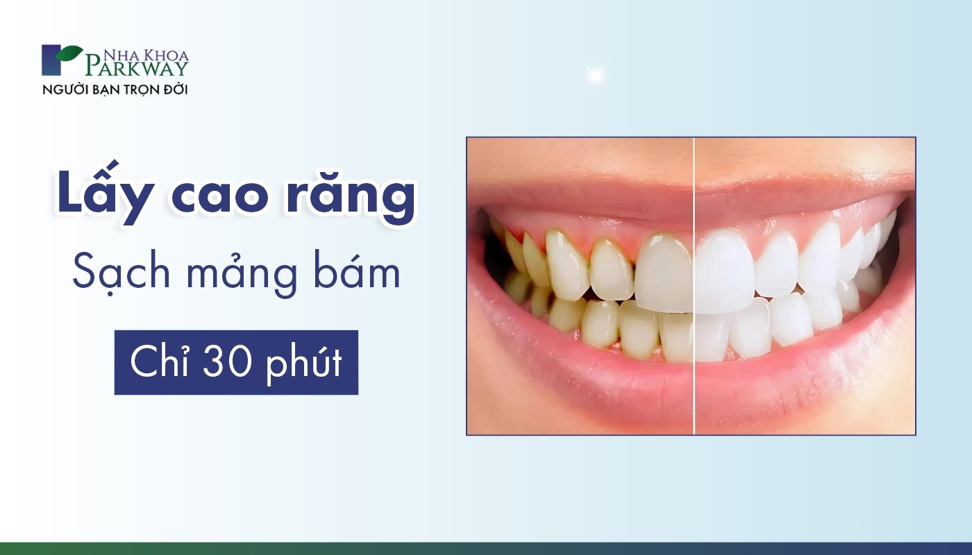 Lấy cao răng sạch mảng bám chỉ 30p