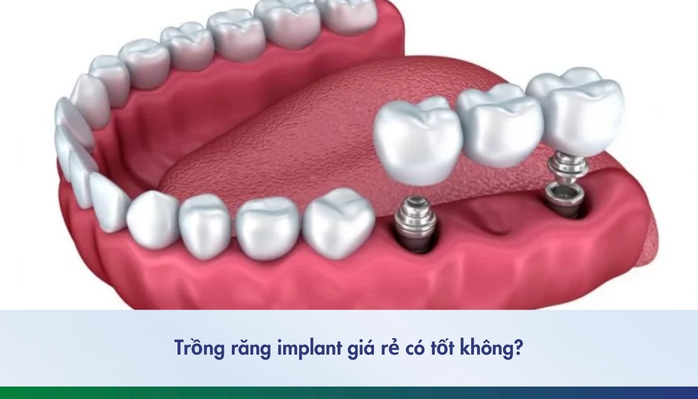 trồng răng implant giá rẻ