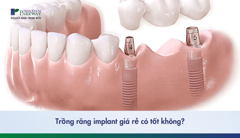 trồng răng implant có tốt không