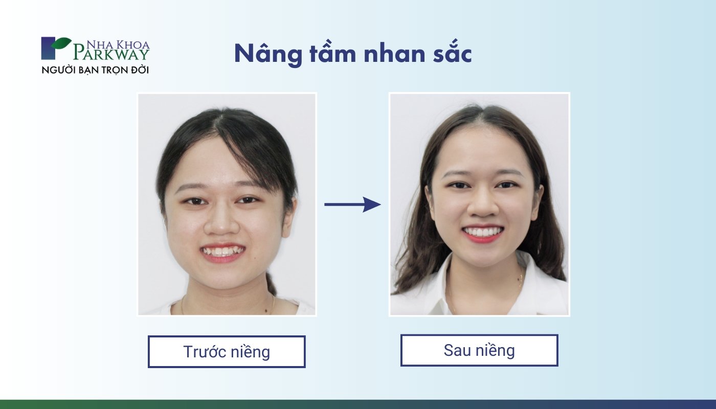 Hình ảnh trước và sau khi niềng mắc cài