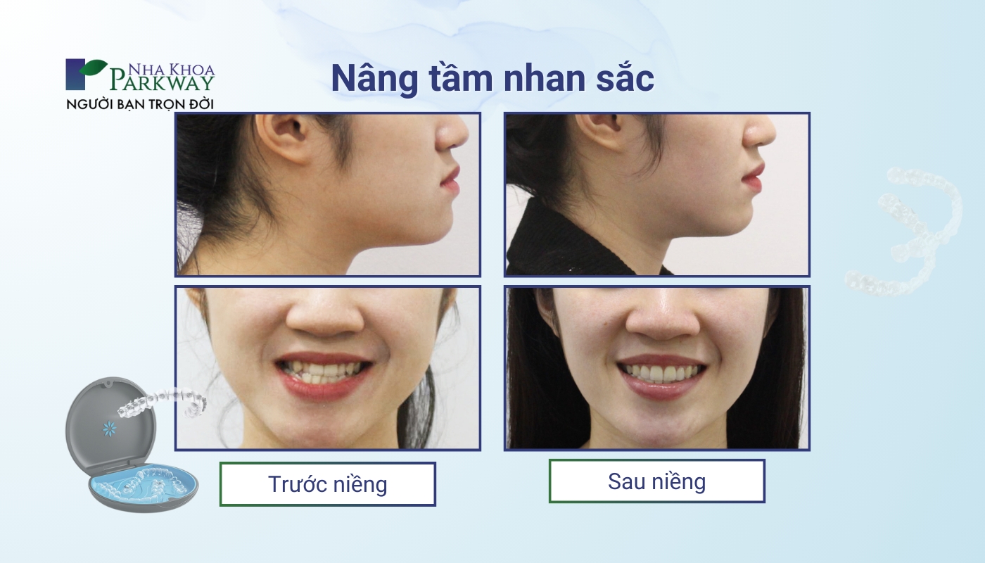 Hình ảnh của khách hàng trước và sau khi niềng răng