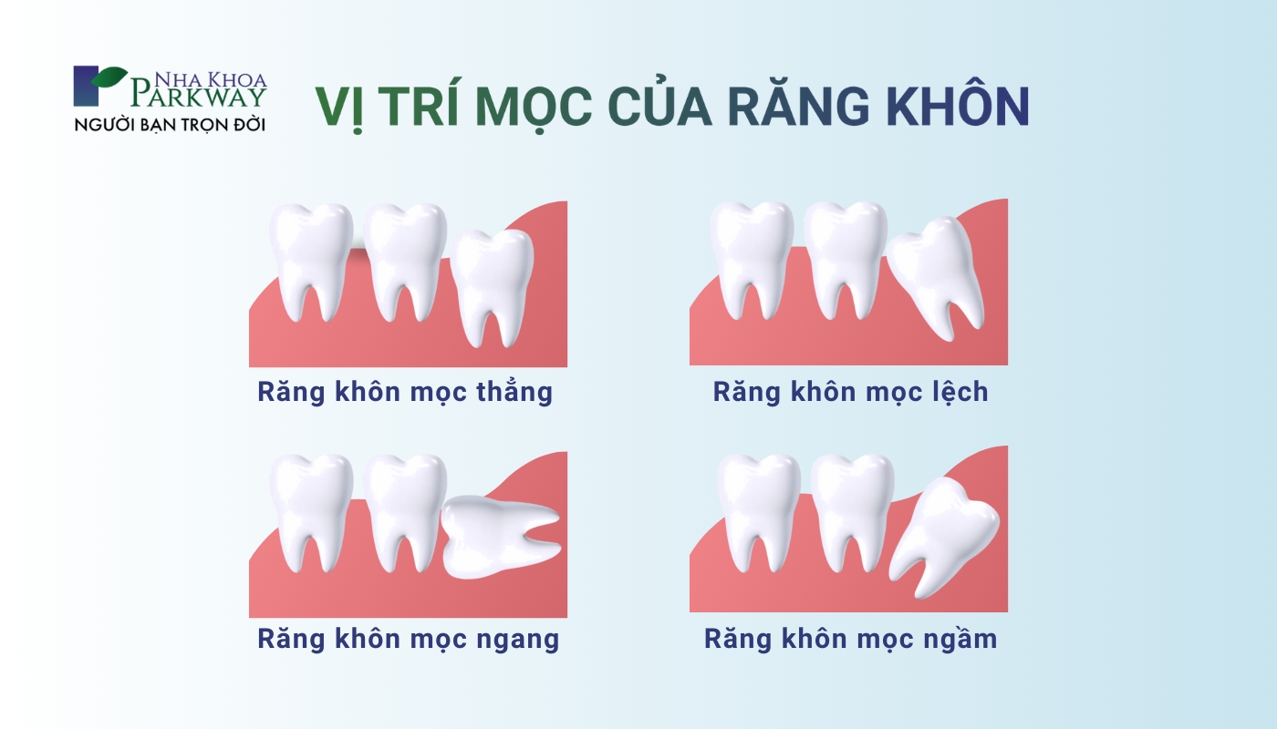 Vị trí mọc của răng khôn: Răng khôn mọc thẳng, răng khôn mọc lệch, rnagư khôn mọc ngang, răng khôn mọc ngầm