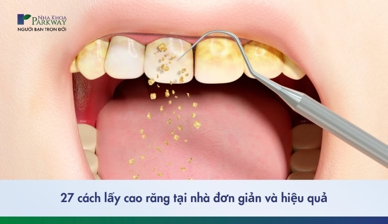 27 cách lấy cao răng tại nhà hiệu quả