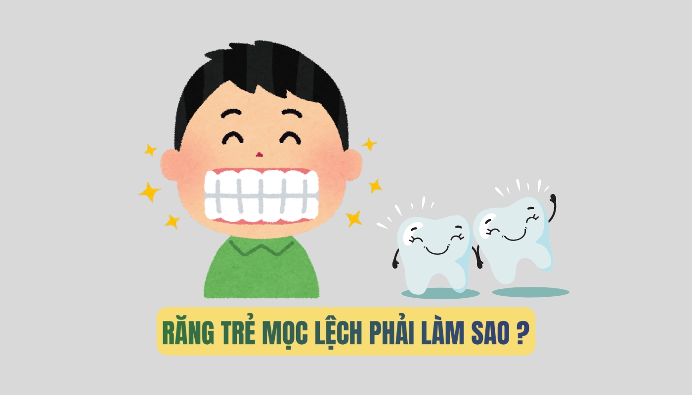 Răng trẻ mọc lệch phải làm sao?