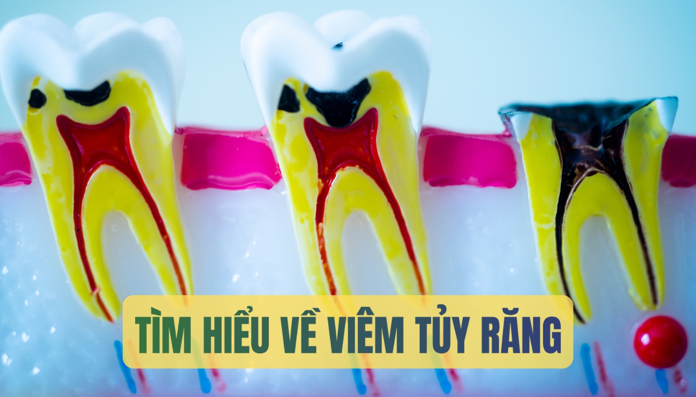 Bệnh viêm tủy răng là gì?