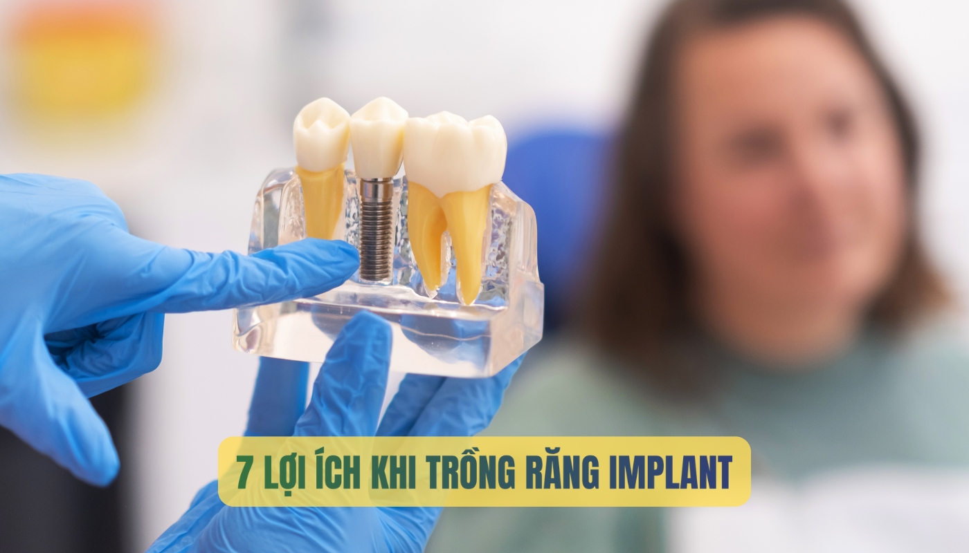 Lợi ích khi trồng răng Implant
