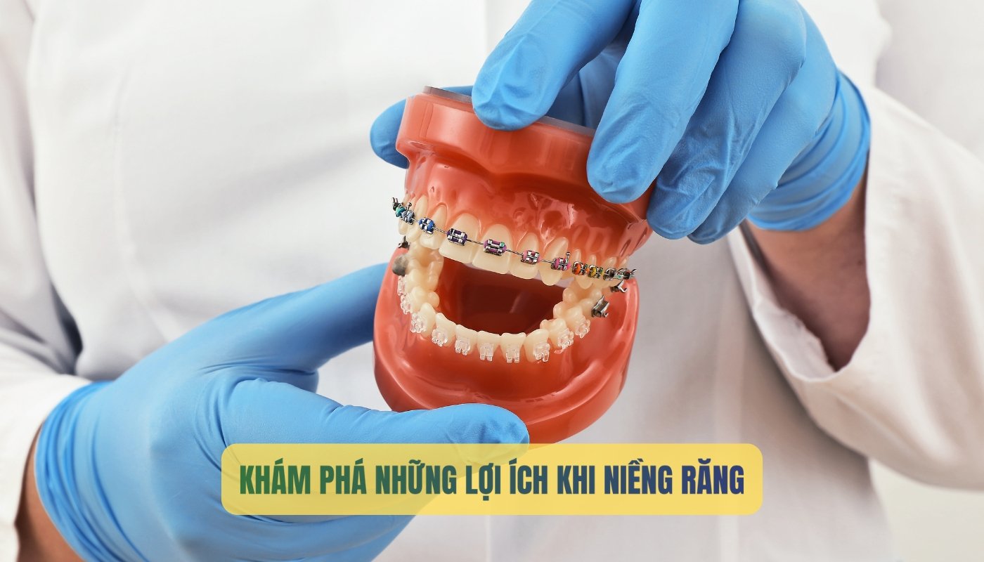 Niềng răng: công dụng và phân loại