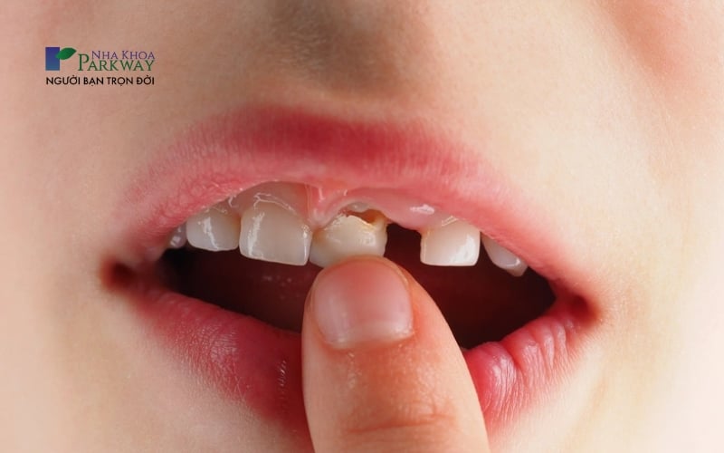 Hình ảnh răng sữa cửa hàm trên bị rụng, việc hình thành răng vĩnh viễn sẽ tạo tác động khiến cho răng sữa phía trên bị lung lay