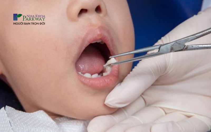 Hình ảnh nhổ răng sữa cho trẻ bằng kềm nha khoa