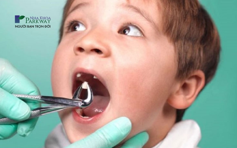 Hình ảnh dùng kềm nha khoa để nhổ răng sữa cho trẻ