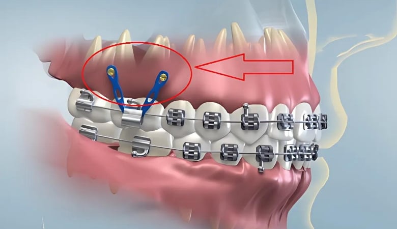 Giai đoạn kéo cụm răng cửa trong niềng răng mất bao lâu?