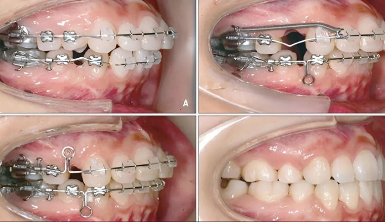 Giai đoạn kéo cụm răng cửa trong niềng răng mất bao lâu?