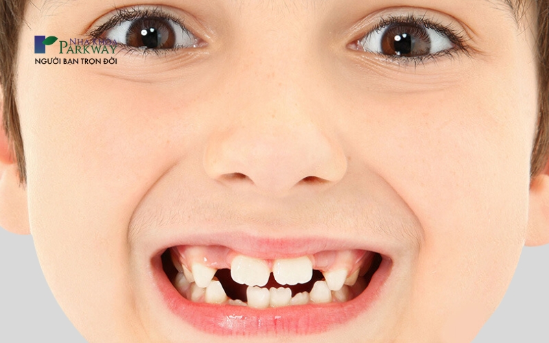 Hình ảnh răng trẻ mọc lệch, thưa thớt và không đồng đều