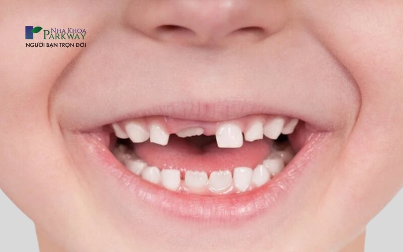 Hình ảnh em bé đang trong quá trình thay răng cửa hàm trên