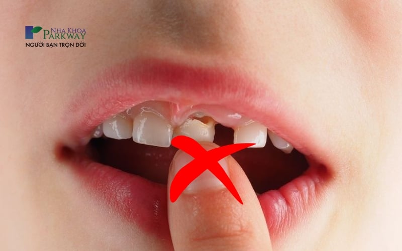 Hình ảnh khuyến cáo không nên để trẻ tự ý nhổ răng sữa khi chưa sẵn sàng rụng