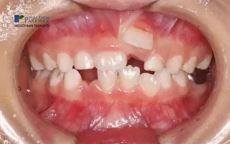 Hàm răng của trẻ mọc không đều, lệch lạc và sai vị trí