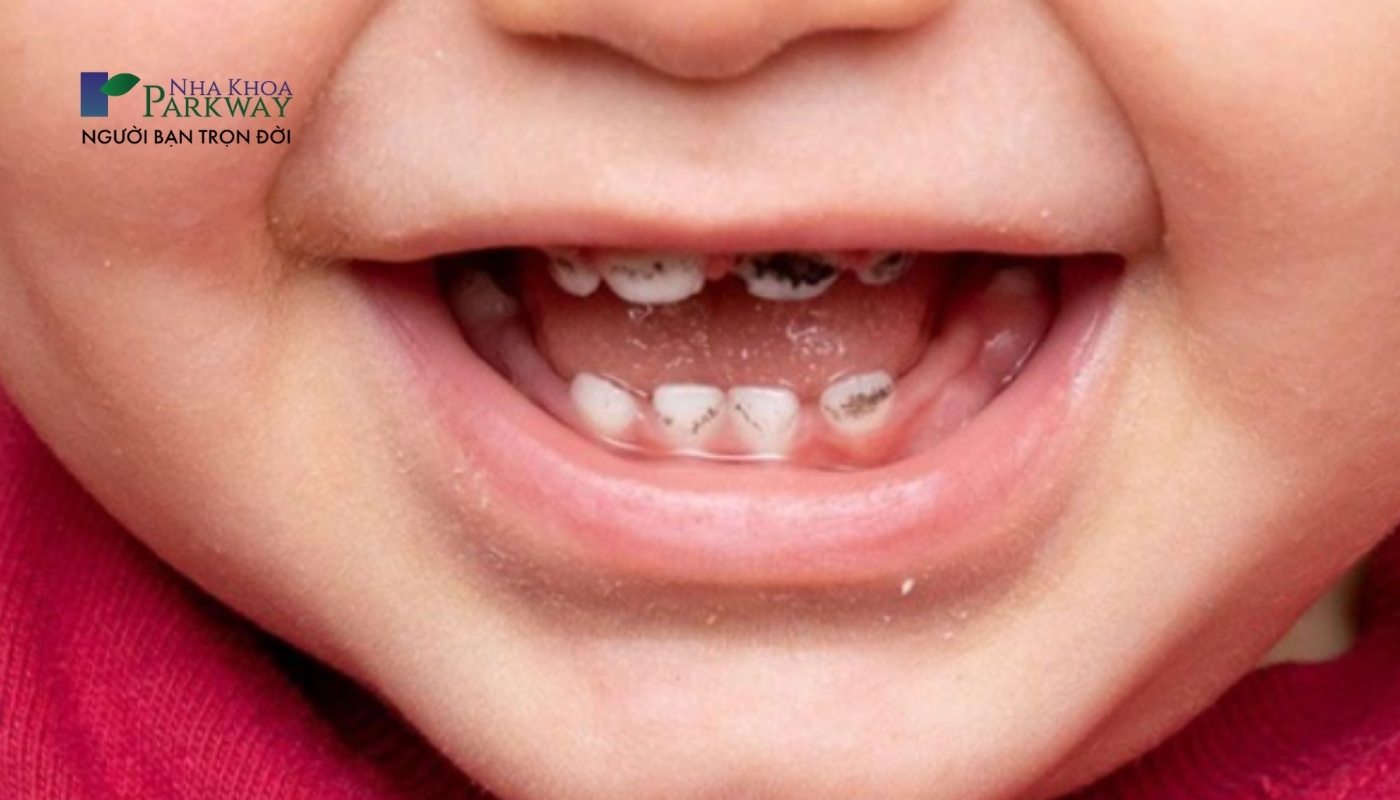 Hình ảnh răng em bé bị sâu có đốm đen