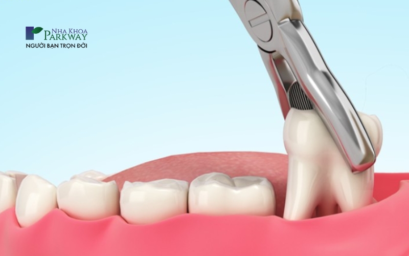 Hình ảnh mô phỏng quá trình nhổ răng khôn bằng dụng cụ nha khoa