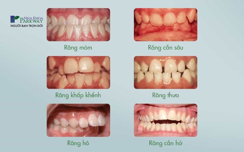 Các trường hợp nên niềng răng như bị móm, khấp khểnh, hô, thưa hoặc khớp cắn sâu