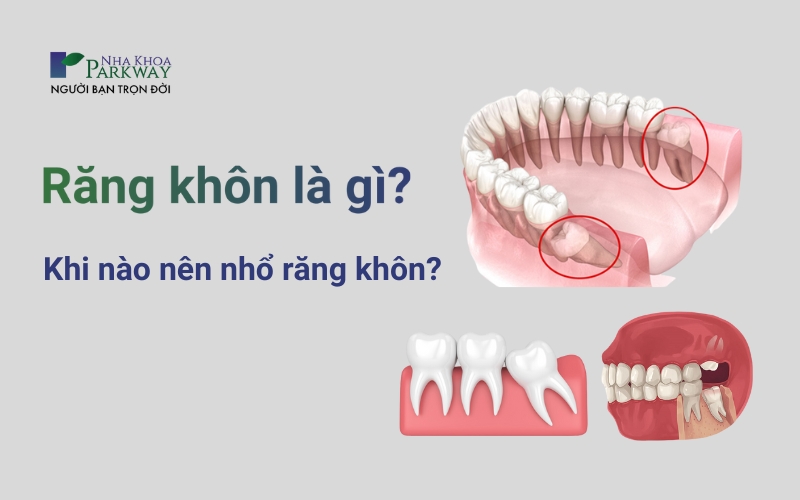 Banner chứa ảnh mô phỏng răng khôn kết hợp với tiêu đề răng khôn là gì? Khi nào nên nhổ răng khôn?