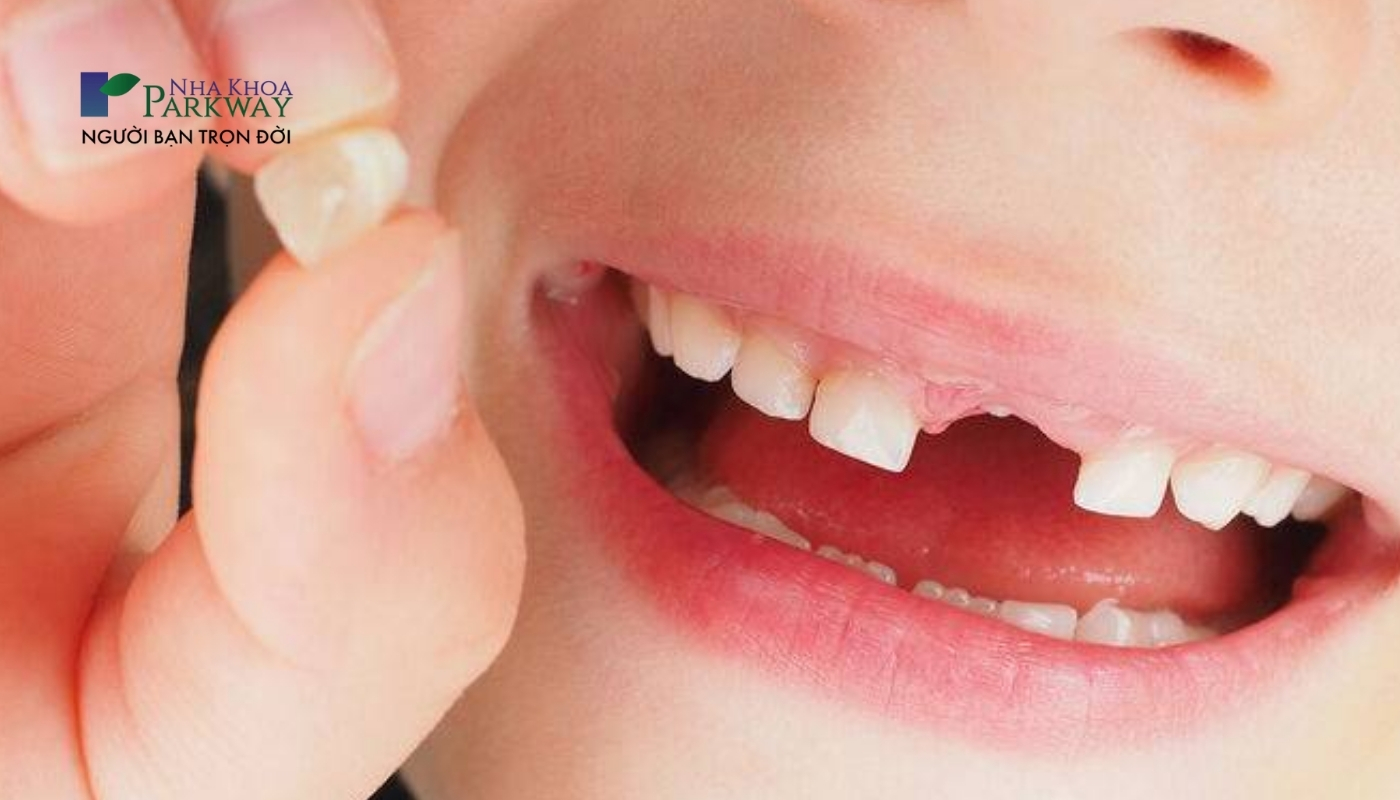Hình ảnh răng cửa hàm trên của em bé đã rụng và sắp nhường chỗ cho răng vĩnh viễn