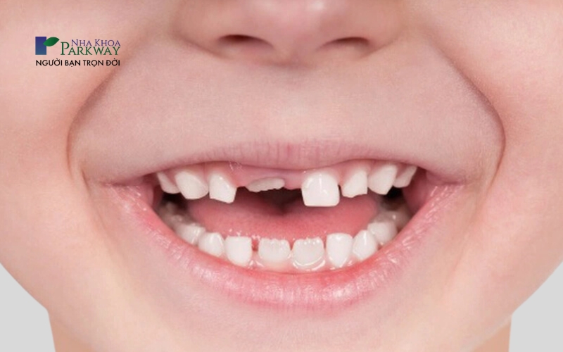 Hình ảnh chiếc răng cửa hàm trên đang mọc lên