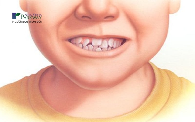 Hình ảnh hàm răng của trẻ em mọc xô lệch, chen chúc