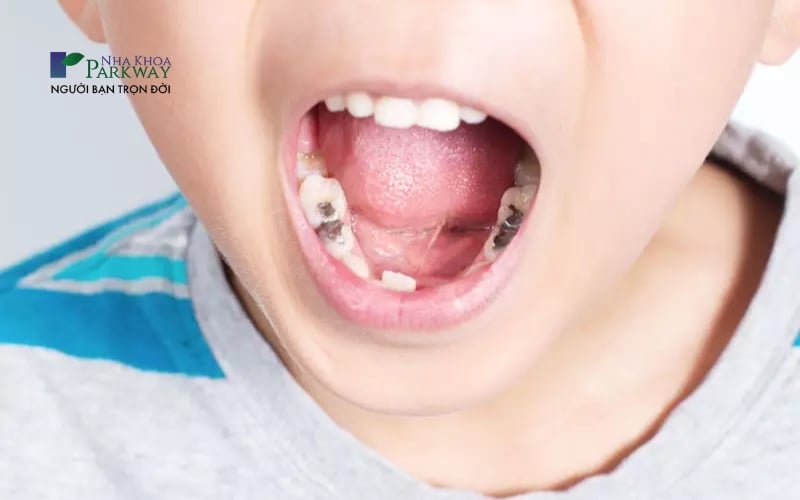 Răng có các đốm đen là biểu hiện của trẻ em bị sâu răng sữa