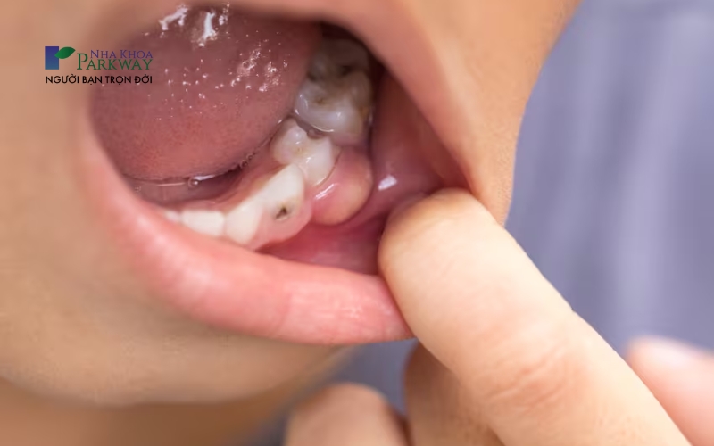 Nướu trẻ bị sưng do sâu răng sữa