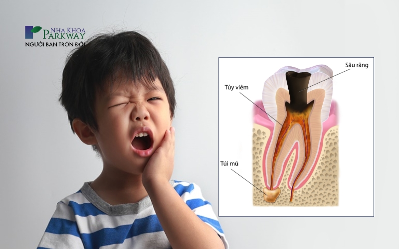 Minh họa trẻ bị đau răng và ảnh sâu răng gây viêm tủy