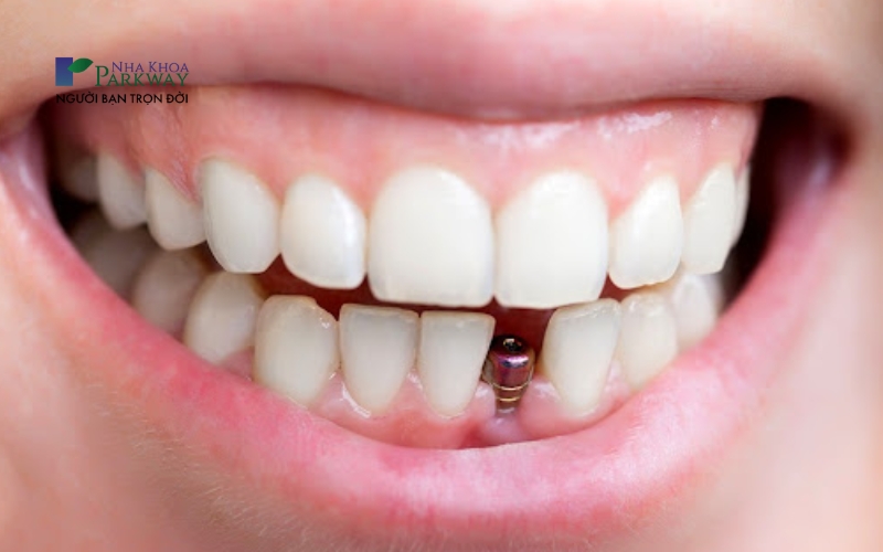 Ảnh hàm răng bị khuyết răng cửa hàm dưới và cấy trụ Implant