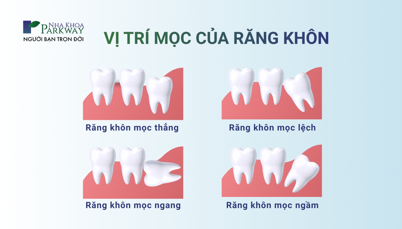 Vị trí mọc của răng khôn, răng số 8: răng khôn mọc thẳng, răng khôn mọc lệch, răng khôn mọc ngang, răng khôn mọc ngầm