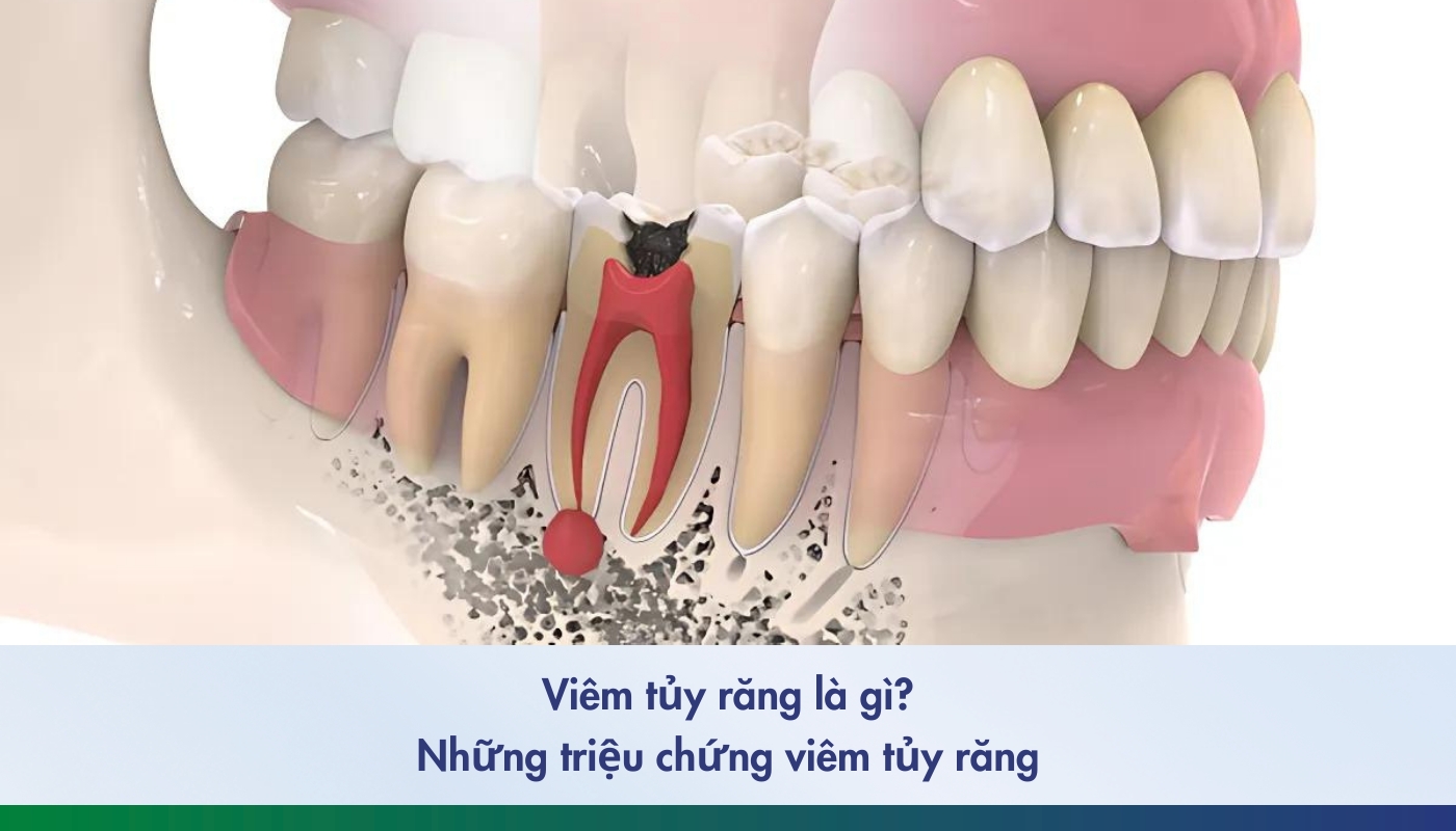 viêm tủy răng là gì? Những triệu chứng viêm tủy răng