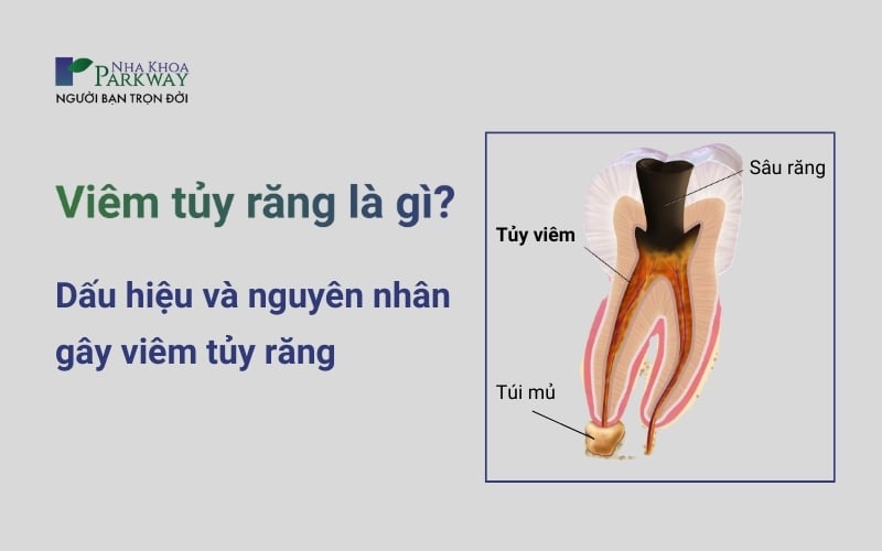 Viêm tủy răng là gì? Dấu hiệu và nguyên nhân gây nên