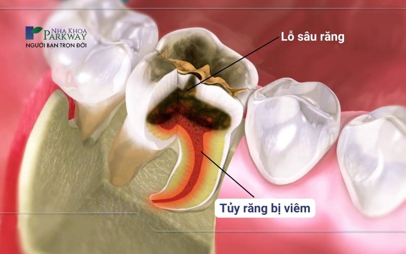 Ảnh minh họa răng bị viêm tủy, nguyên nhân do có lỗ sâu răng tạo điều kiện để vi khuẩn xâm nhập gây viêm