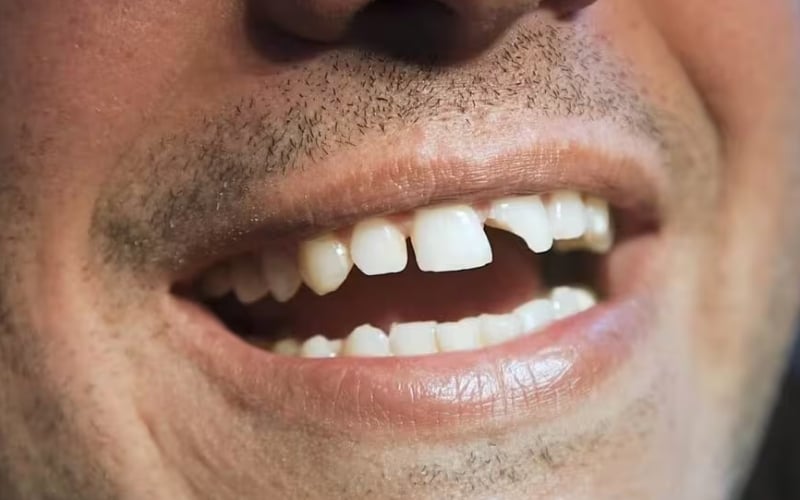 Hình ảnh răng cửa bị sứt mẻ, nguyên nhân có thể gây nên viêm tủy răng