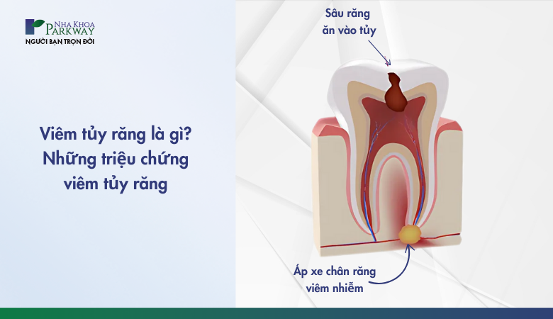 viêm tủy răng và những triệu chứng