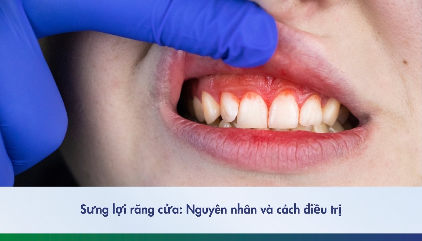 Sưng lợi răng cửa