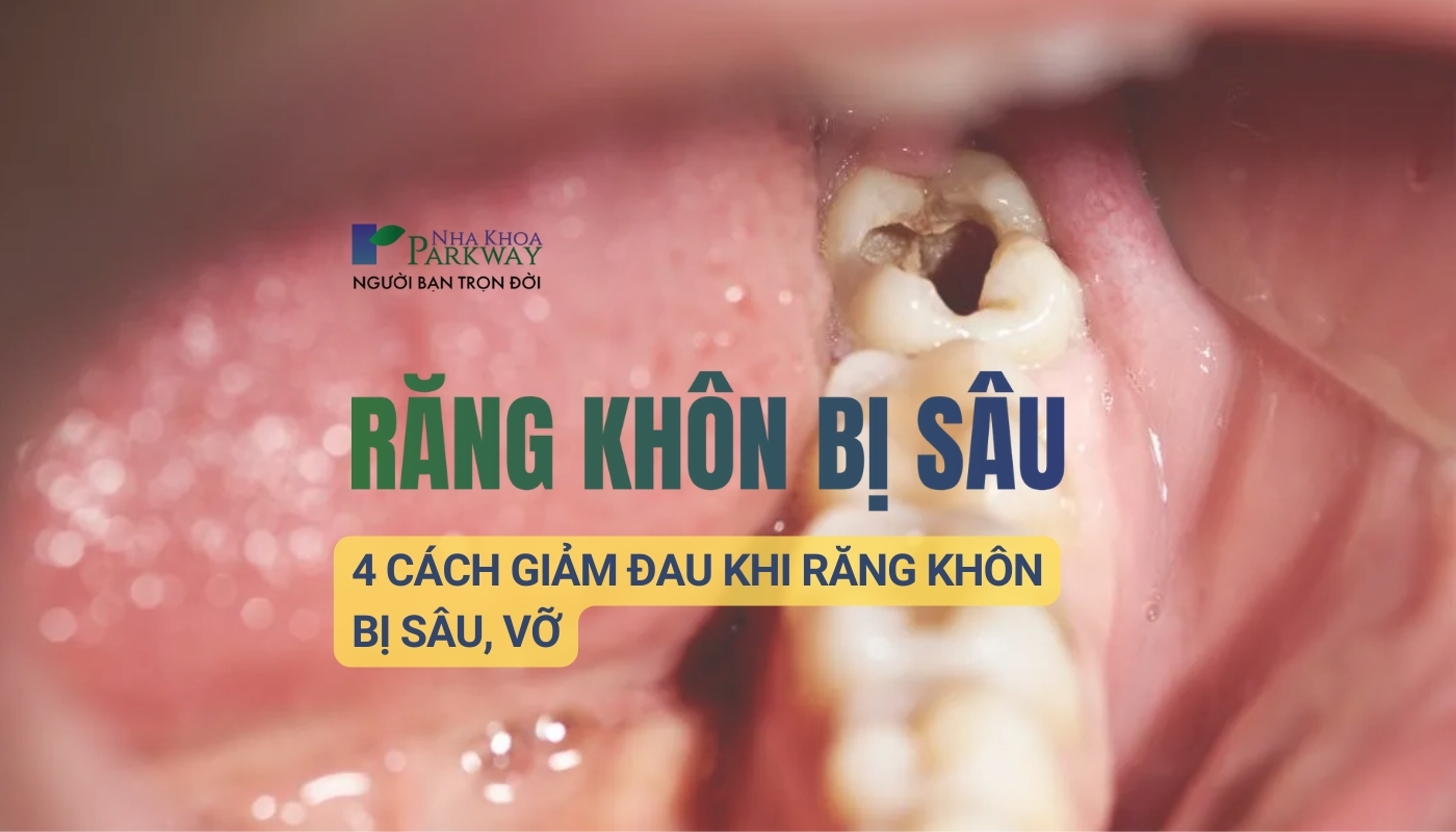 Răng khôn bị sâu vỡ