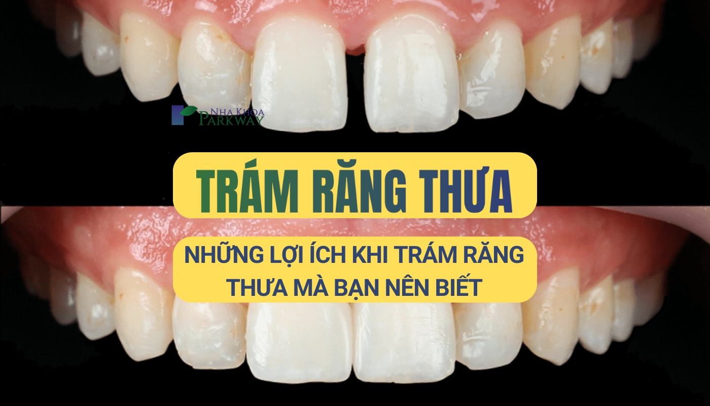 Răng thưa có trám được không?